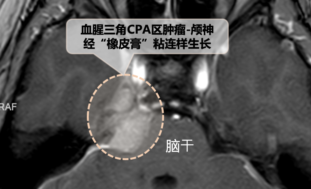 天壇醫(yī)院手術(shù)隨訪 | “無癥狀”腦瘤要不要切？一場手術(shù)讓她